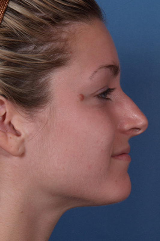 Rhinoplasty Before & After Photo