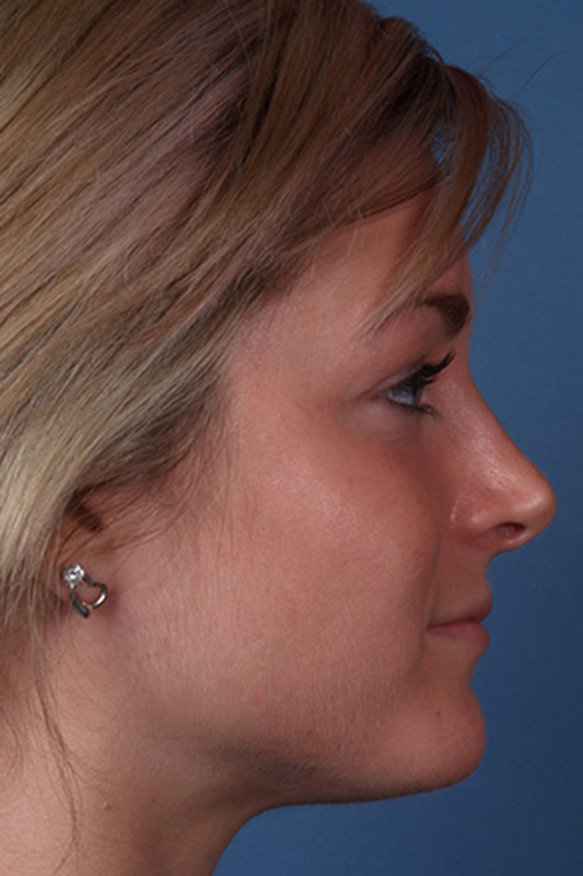 Rhinoplasty Before & After Photo