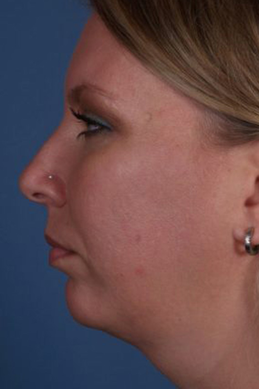 Rhinoplasty Before & After Photo