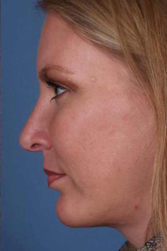 Rhinoplasty Before & After Photo