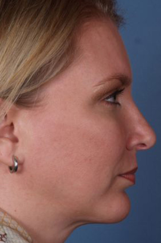 Rhinoplasty Before & After Photo