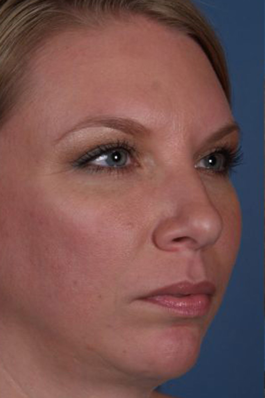 Rhinoplasty Before & After Photo