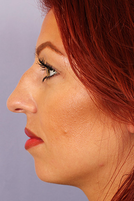 Rhinoplasty Before & After Photo