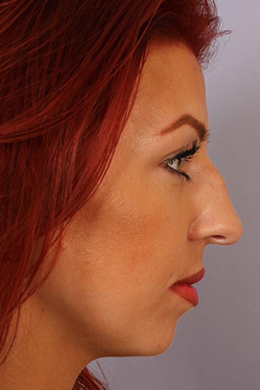 Rhinoplasty Before & After Photo