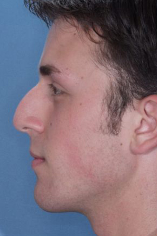 Rhinoplasty Before & After Photo