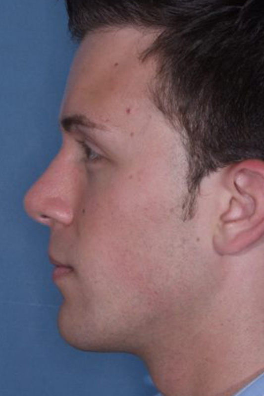 Rhinoplasty Before & After Photo