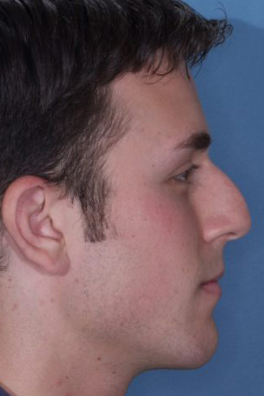 Rhinoplasty Before & After Photo