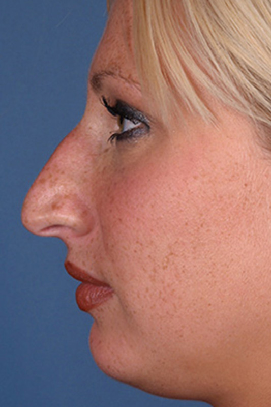 Rhinoplasty Before & After Photo