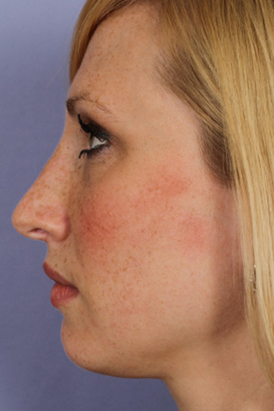 Rhinoplasty Before & After Photo