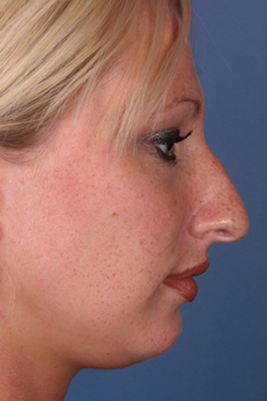 Rhinoplasty Before & After Photo