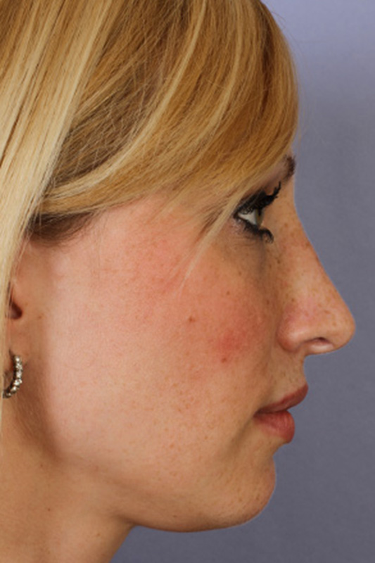 Rhinoplasty Before & After Photo