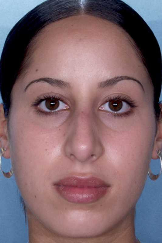 Rhinoplasty Before & After Photo