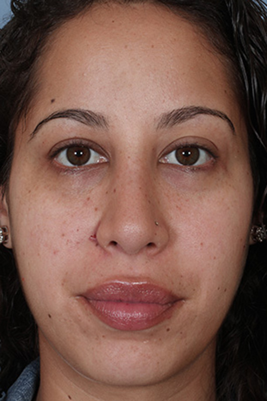 Rhinoplasty Before & After Photo