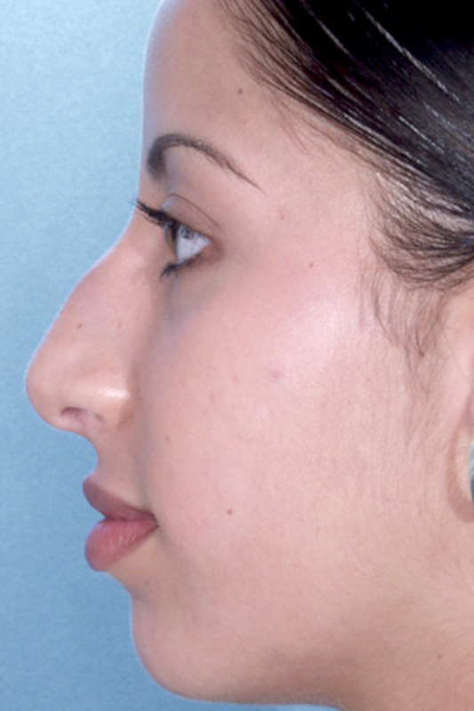 Rhinoplasty Before & After Photo