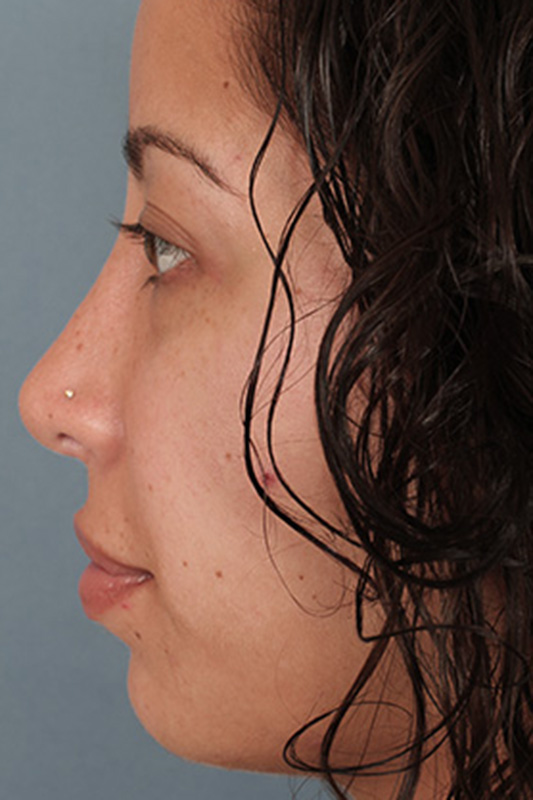 Rhinoplasty Before & After Photo