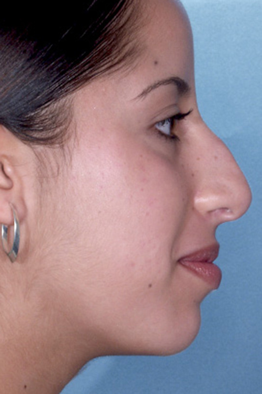 Rhinoplasty Before & After Photo