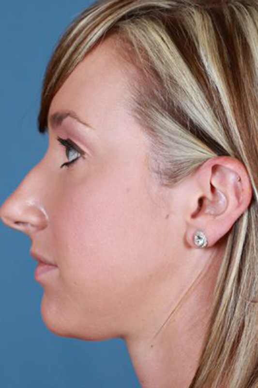 Rhinoplasty Before & After Photo