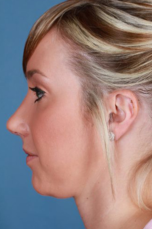 Rhinoplasty Before & After Photo