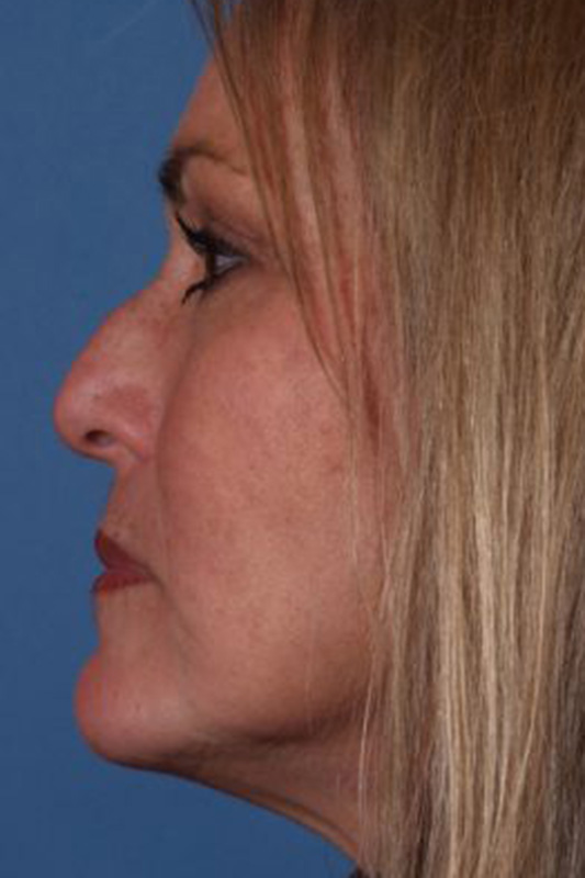 Rhinoplasty Before & After Photo