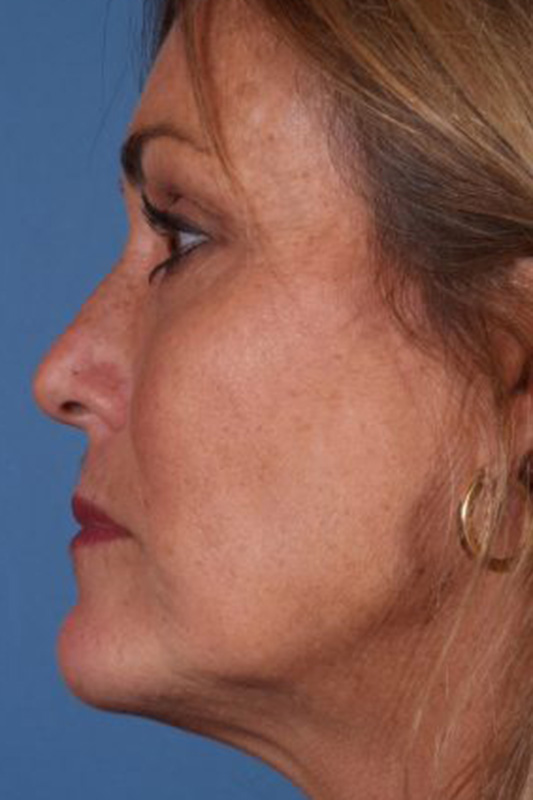 Rhinoplasty Before & After Photo