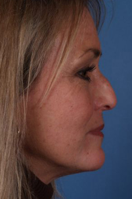 Rhinoplasty Before & After Photo