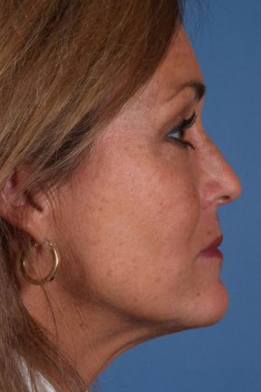 Rhinoplasty Before & After Photo