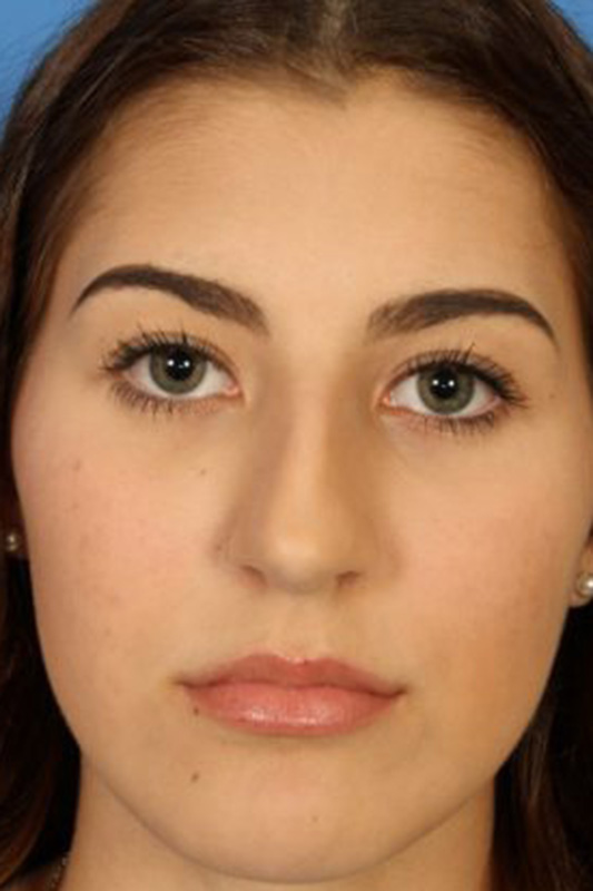 Rhinoplasty Before & After Photo