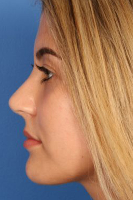 Rhinoplasty Before & After Photo