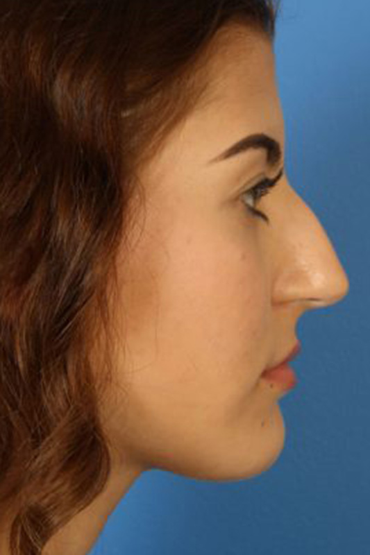 Rhinoplasty Before & After Photo