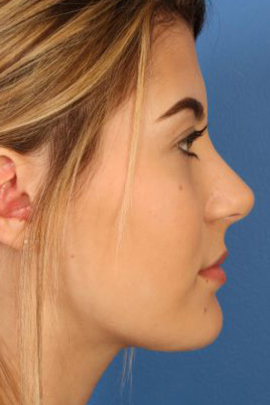 Rhinoplasty Before & After Photo