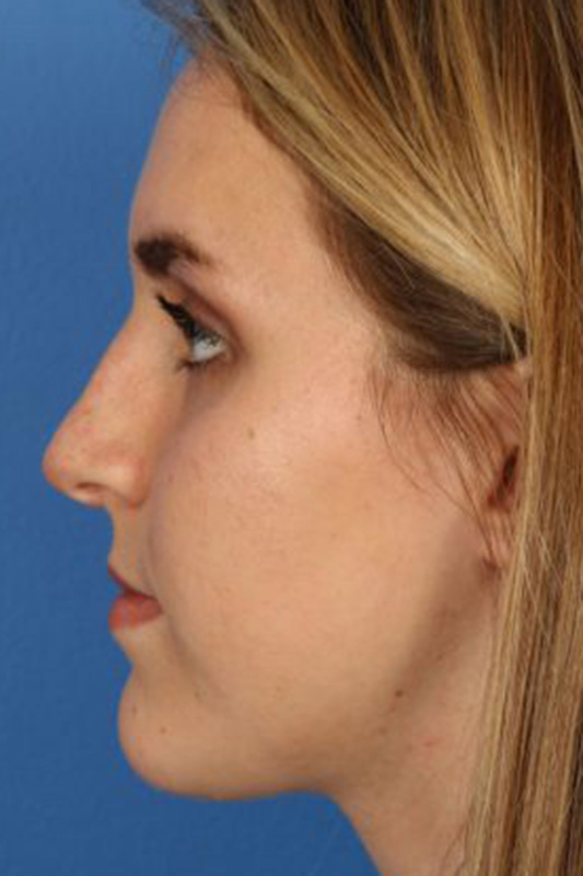 Rhinoplasty Before & After Photo