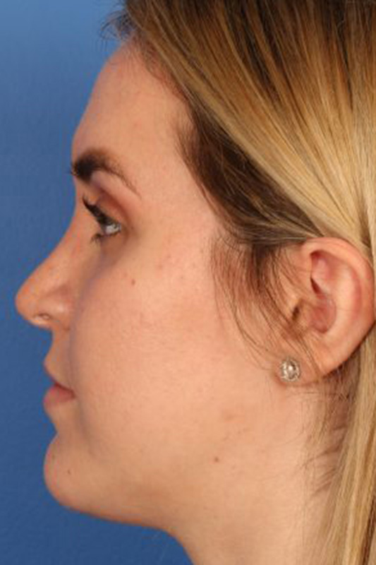 Rhinoplasty Before & After Photo