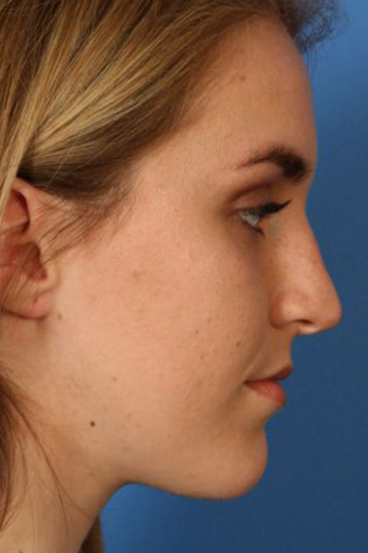 Rhinoplasty Before & After Photo