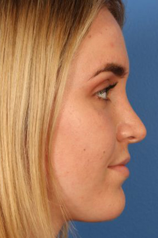 Rhinoplasty Before & After Photo