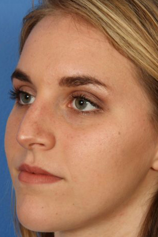 Rhinoplasty Before & After Photo