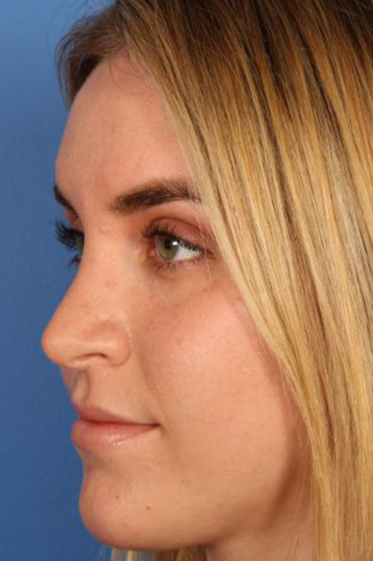 Rhinoplasty Before & After Photo