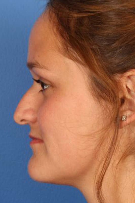 Rhinoplasty Before & After Photo