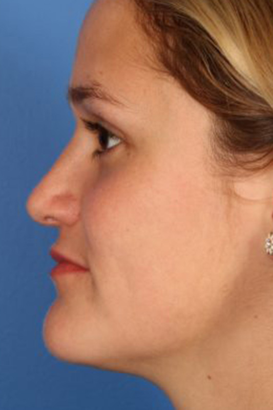 Rhinoplasty Before & After Photo