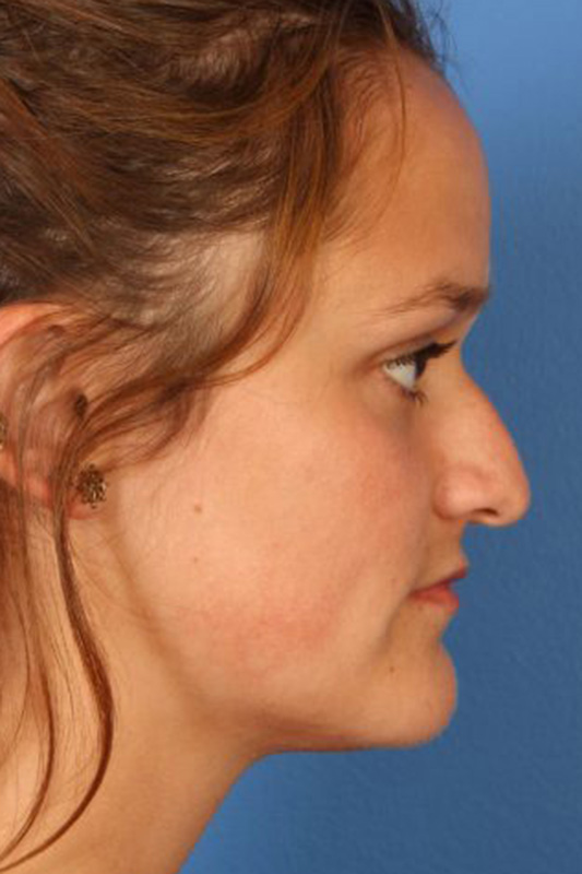 Rhinoplasty Before & After Photo