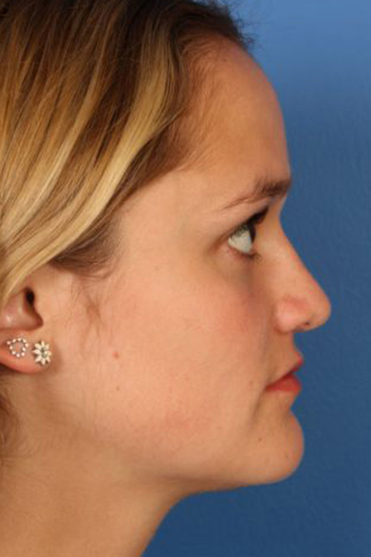 Rhinoplasty Before & After Photo