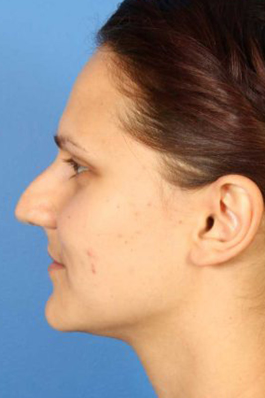 Rhinoplasty Before & After Photo