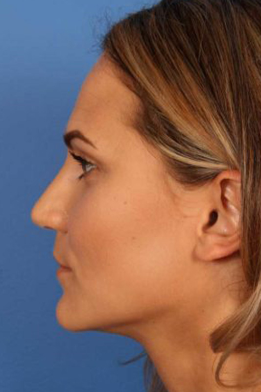 Rhinoplasty Before & After Photo