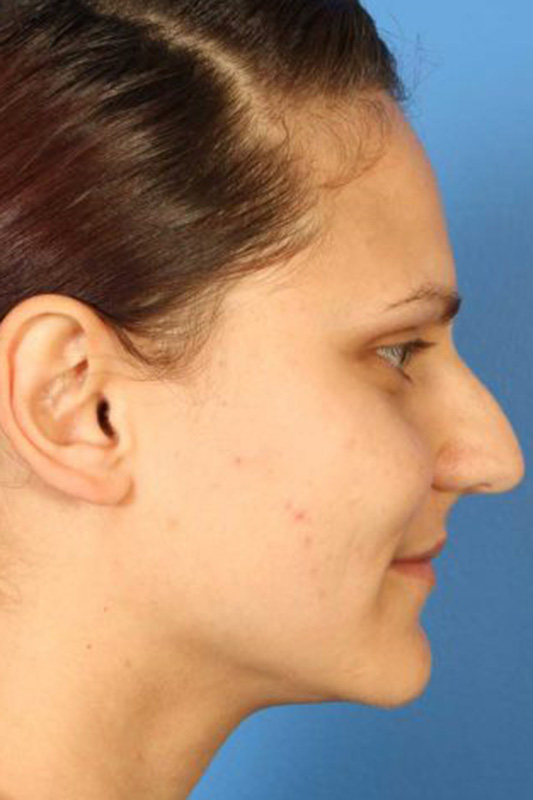 Rhinoplasty Before & After Photo