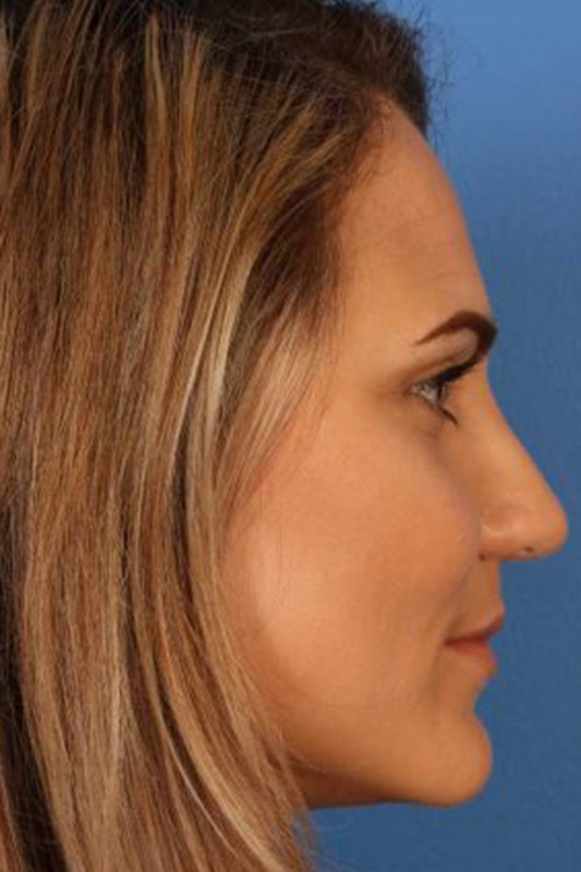 Rhinoplasty Before & After Photo