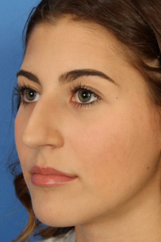 Rhinoplasty Before & After Photo