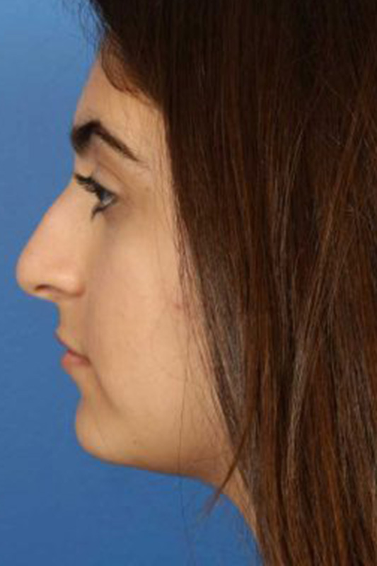 Rhinoplasty Before & After Photo