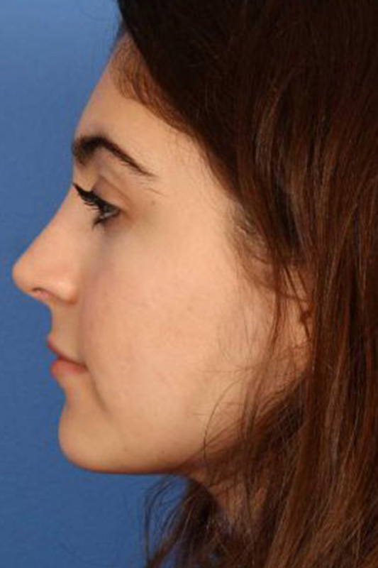 Rhinoplasty Before & After Photo