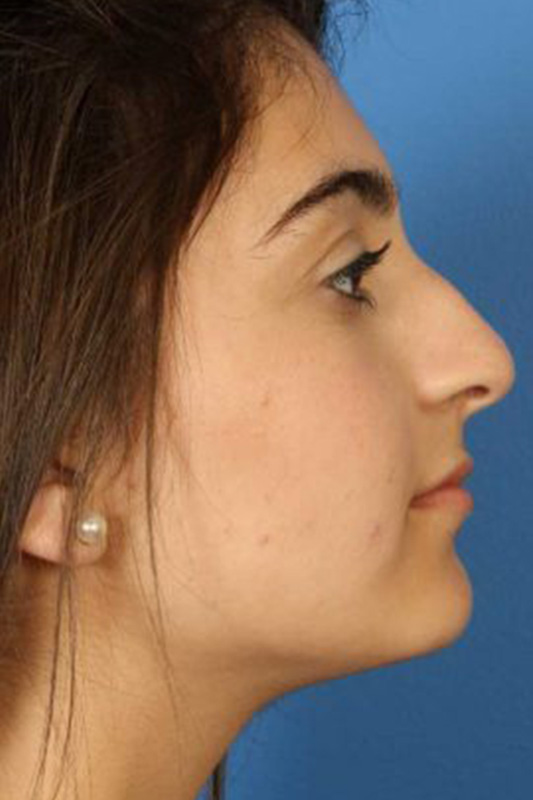 Rhinoplasty Before & After Photo