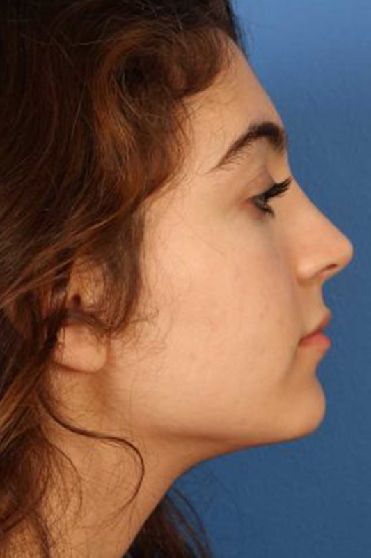 Rhinoplasty Before & After Photo