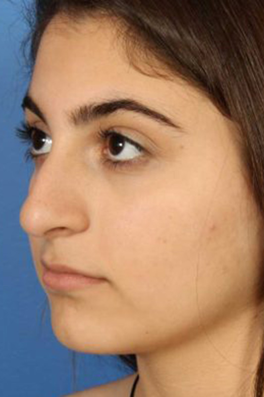 Rhinoplasty Before & After Photo